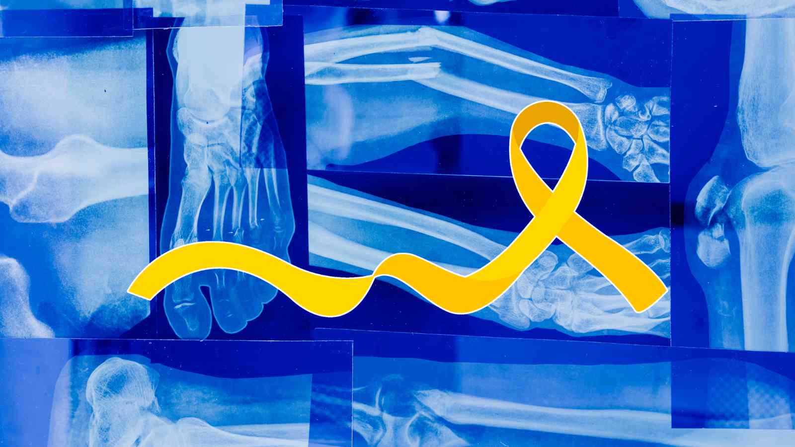 E' una nuova speranza per i pazienti affetti da osteosarcoma quella presentata dai ricercatori, che utilizzano il gallio contro il cancro.